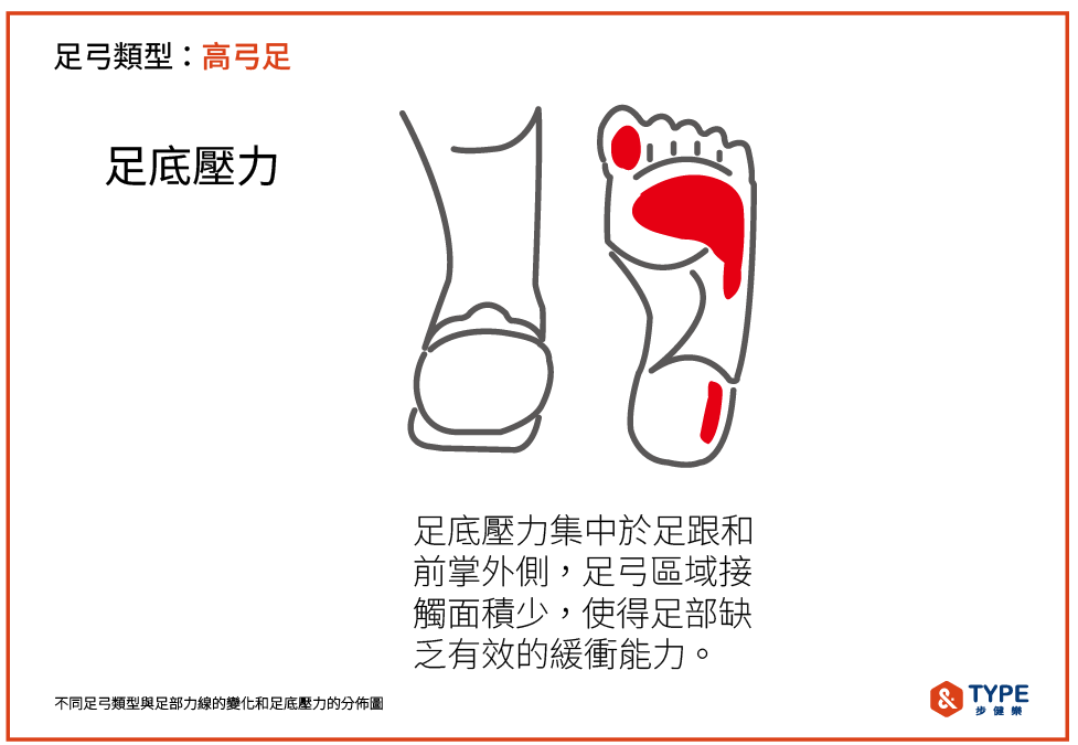 高弓足的足底壓力分佈方式