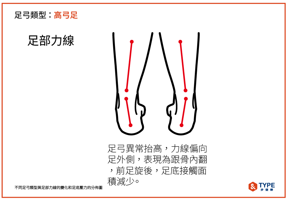 高弓足的足部力線